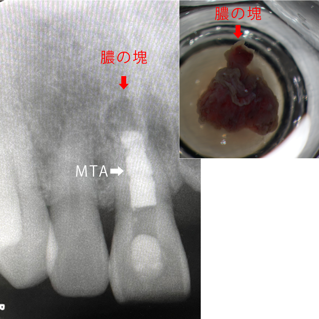 歯根端切除術